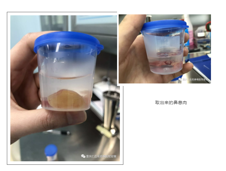 鼻息肉怎么治疗
