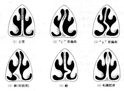 鼻中隔偏曲