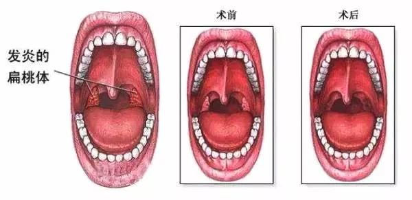 扁桃体炎的危害