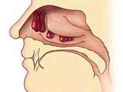 重庆鼻息肉的危害有哪些
