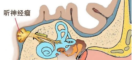 听神经瘤