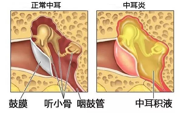 重庆中耳炎医院哪家好