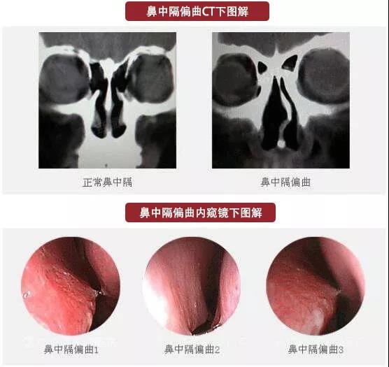 鼻中隔偏曲