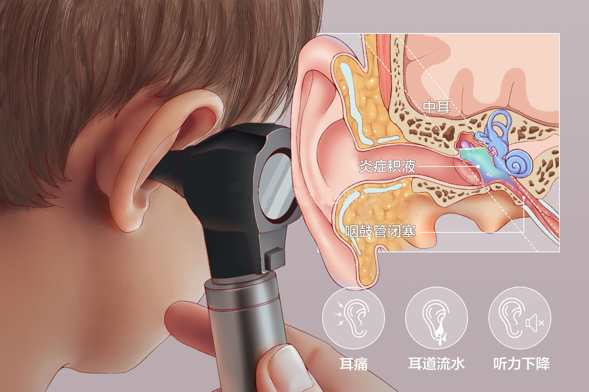 儿童分泌性中耳炎