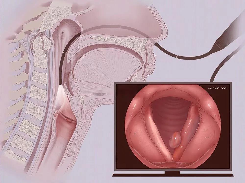 声带息肉的常见症状