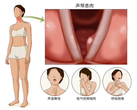 声带息肉