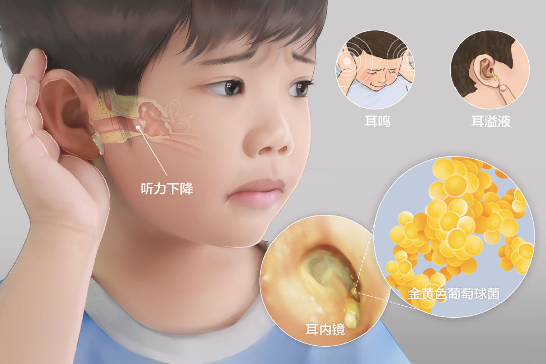 重庆儿童中耳炎
