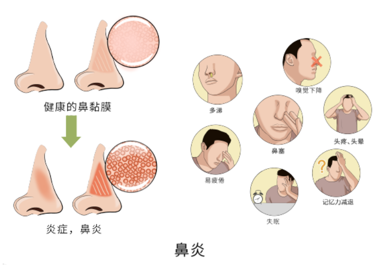 鼻炎鉴别方法