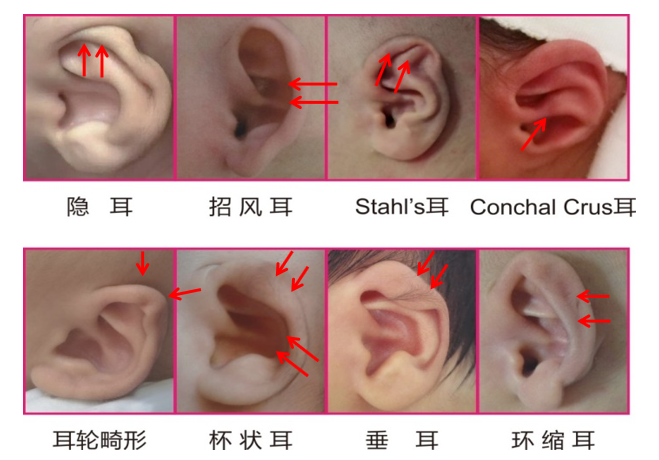 重庆治疗小耳畸形医院